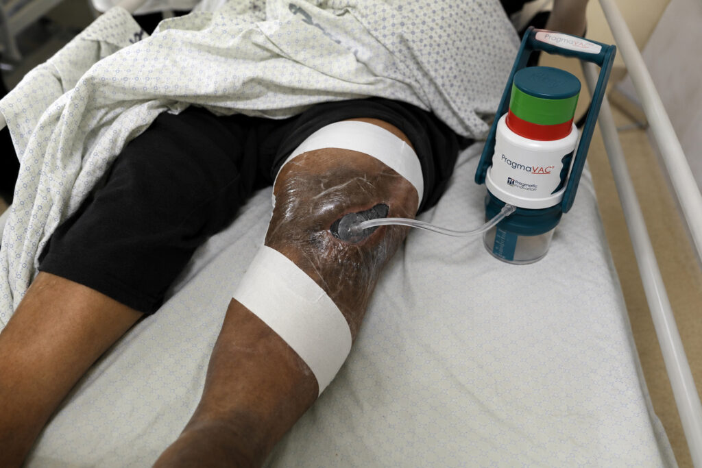 Chronic Wounds are wounds caused by chronic conditions such as diabetic foot ulcers or bed sore in bed ridden patients.​